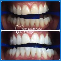 Teeth Whitening Sydney image 2